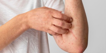 tratamiento de psoriasis v2